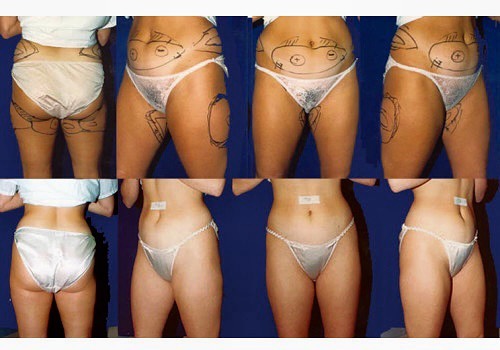 Instagram post by Dr. Woodward Coleman: Liposuction is a great way to enhance shape and remove fat that you cannot seem to get rid of through diet and exercise. Let Dr. Coleman hel…