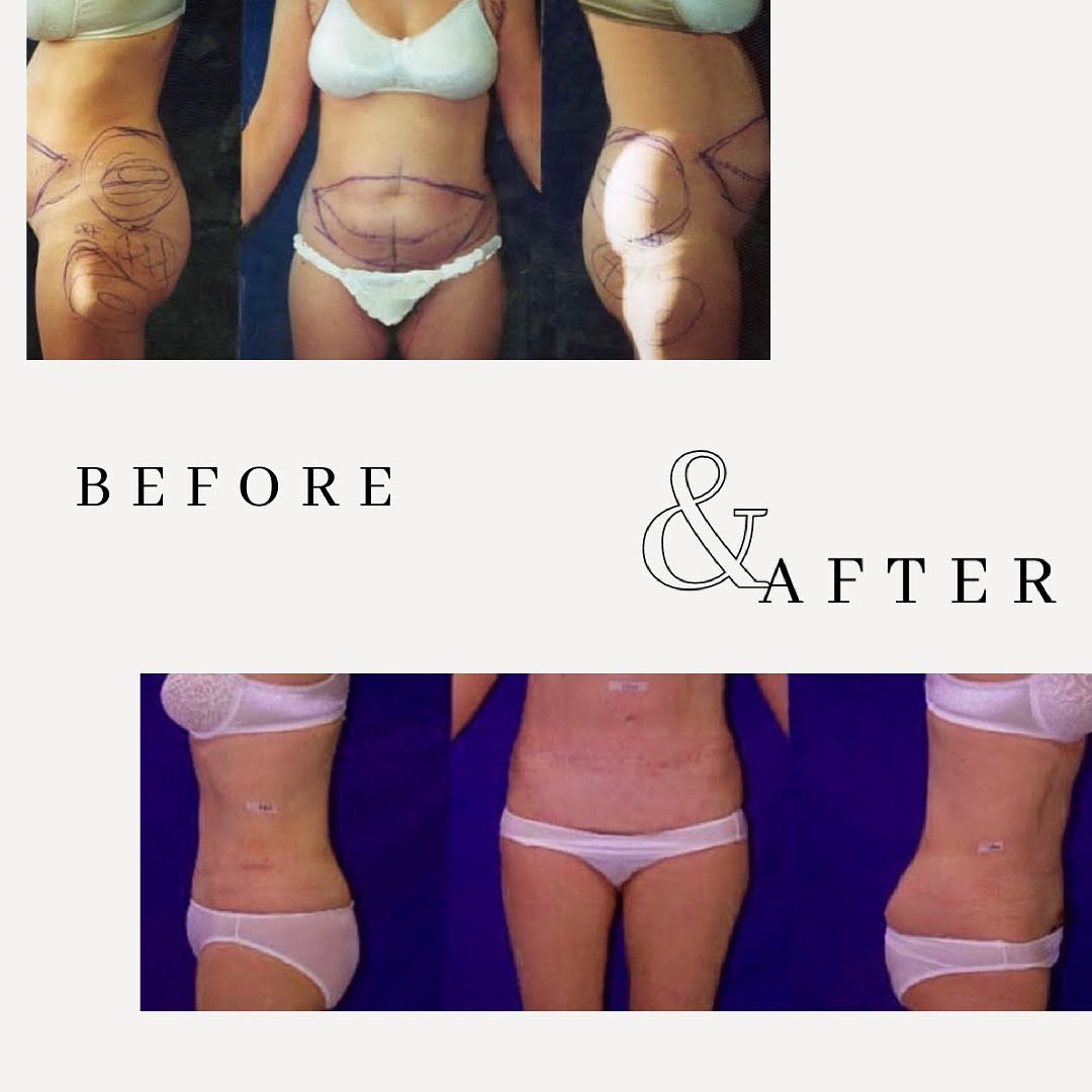 Instagram post by Dr. Woodward Coleman: I gave this patient a new look and restored her confidence after weight loss. This is a formal abdominoplasty (AKA tummy tuck) that removed …