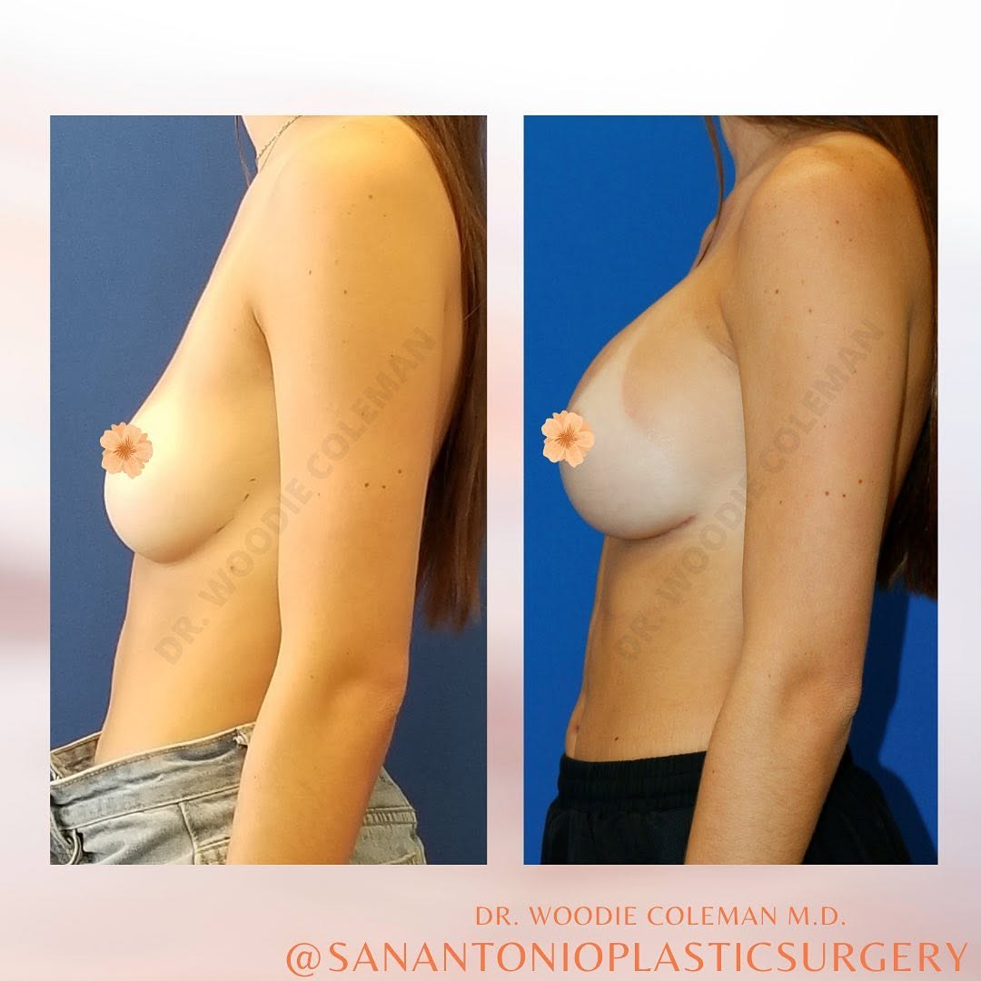 Instagram post by Dr. Woodward Coleman: Unlike silicone implants that tend to settle to the bottom part of the breast and have the possibility of leaking, gel implants maintain the…