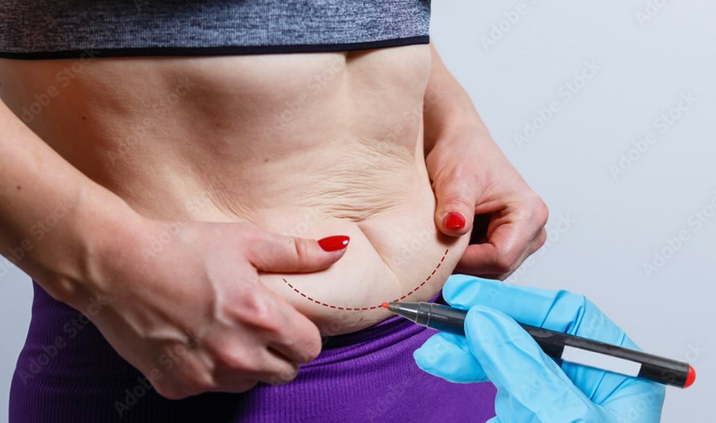 Instagram post by Dr. Woodward Coleman: 🌟 Transform your post-pregnancy body with a Mommy Makeover! 🌟 If saggy stomach skin has you feeling less than your best, Dr. Woodward Cole…