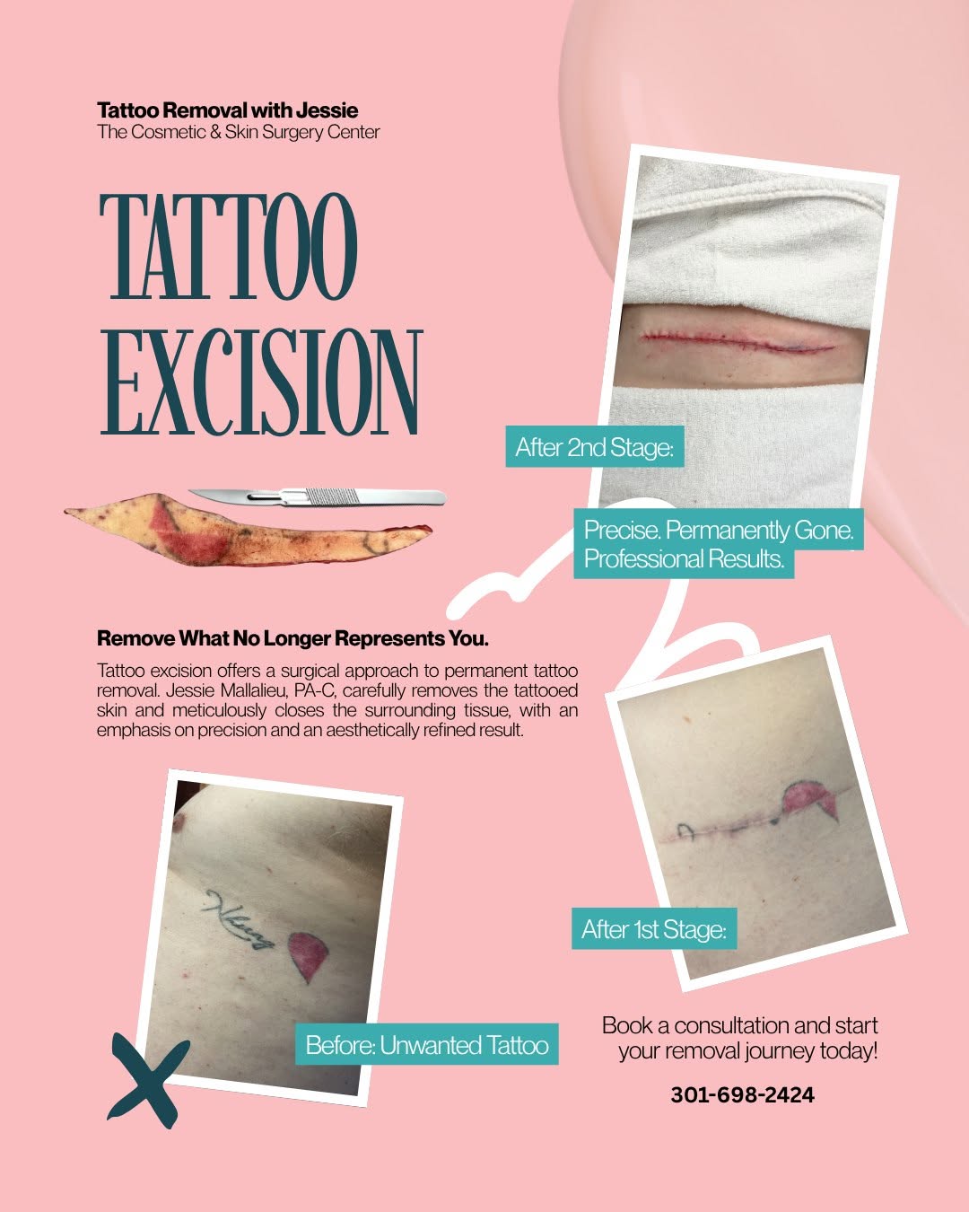 Instagram post by Dr. Wyatt C. To: Ready to let it go? ✨ When laser isn’t the right option for tattoo removal, surgical excision may be an alternative. During tattoo excision,…