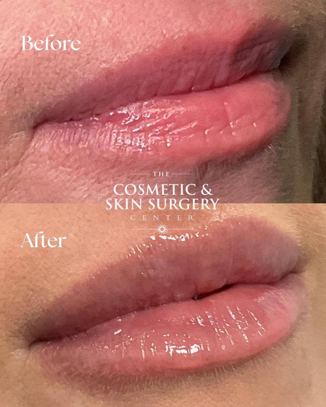 Instagram post by Dr. Wyatt C. To: A little volume. A lot of refinement. 💋 One syringe, thoughtfully placed to enhance her natural shape and create soft, beautifully balanced…