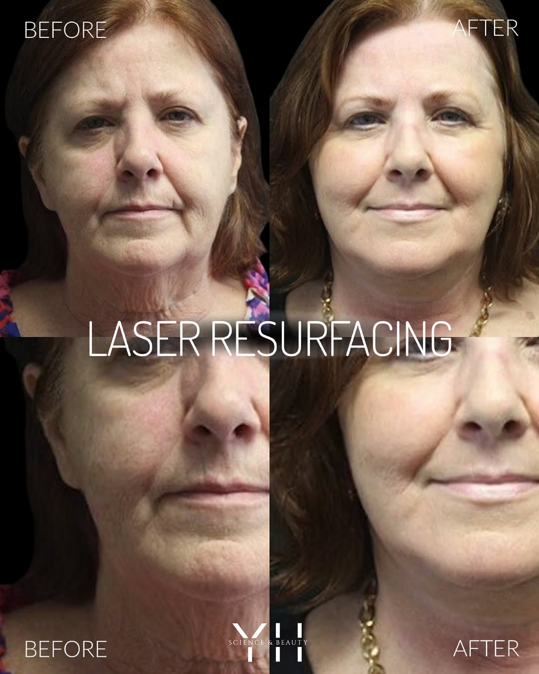 Instagram post by Dr. Yael Halaas: Laser resurfacing is about improving the skin you’re in, not changing the face you recognize. By delivering controlled laser energy into the…
