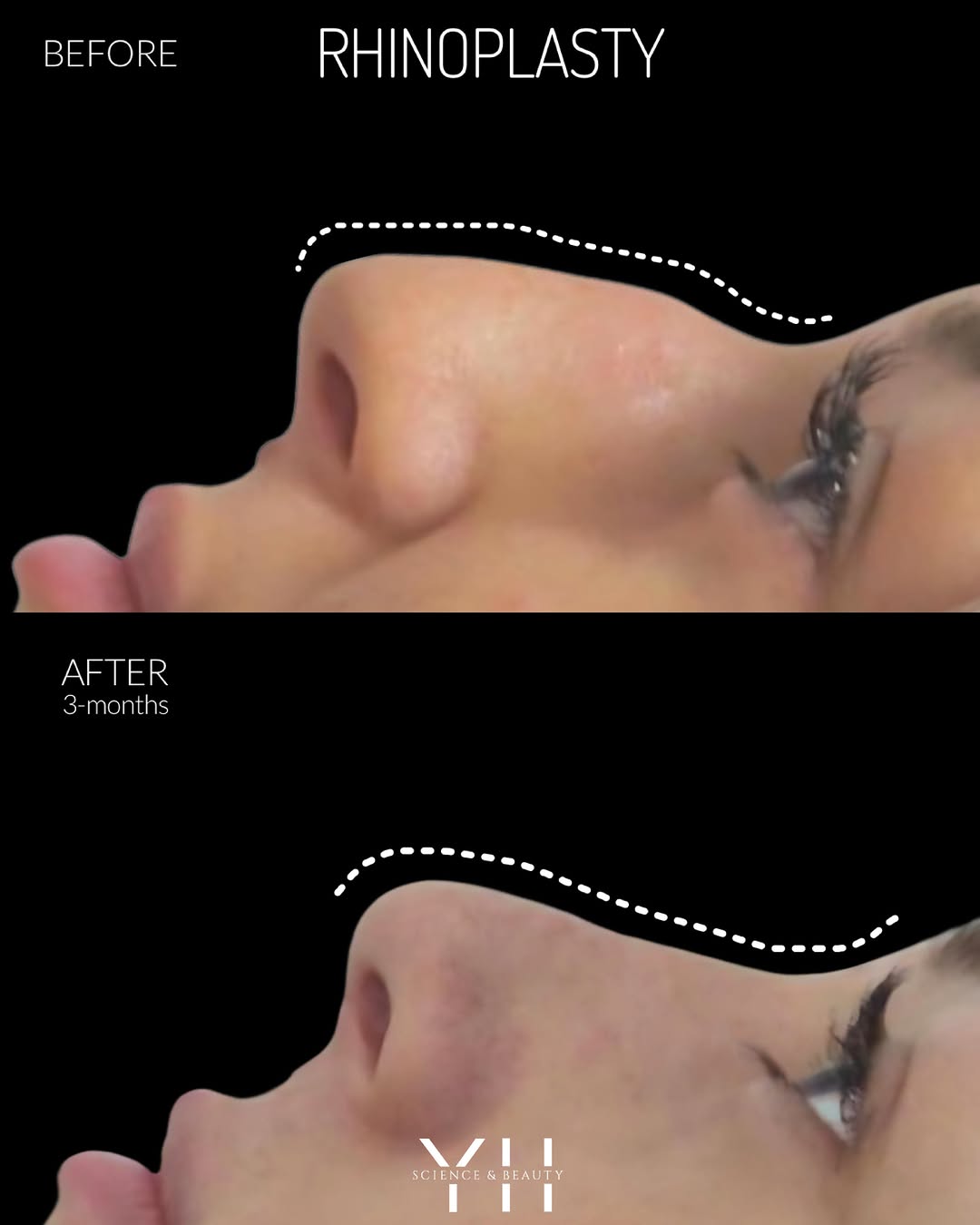 Instagram post by Dr. Yael Halaas: Rhinoplasty at 3 months. 👃 The profile already shows a smoother bridge, a more refined shape, and better balance from the forehead through …