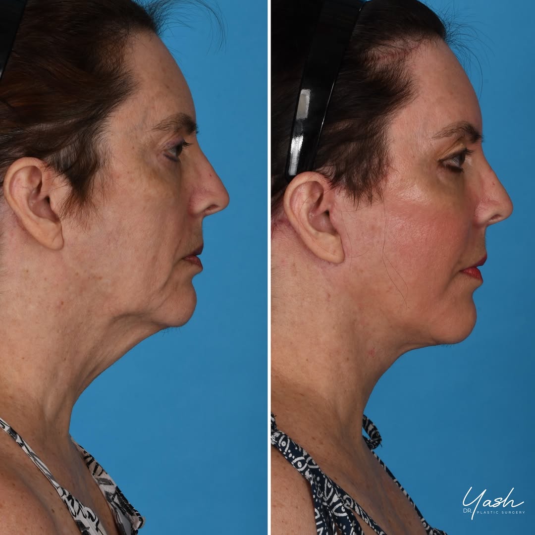 Instagram post by Dr. Yash Avashia: A complete facial refresh✨ This 63-year-old patient came to me seeking comprehensive facial rejuvenation — she wanted to look like herself a…