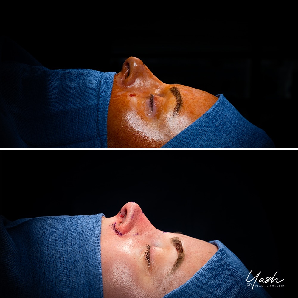 Instagram post by Dr. Yash Avashia: Two decades of living with a nose that never felt like her. 🌿 This patient came to me for a secondary rhinoplasty after her original surger…
