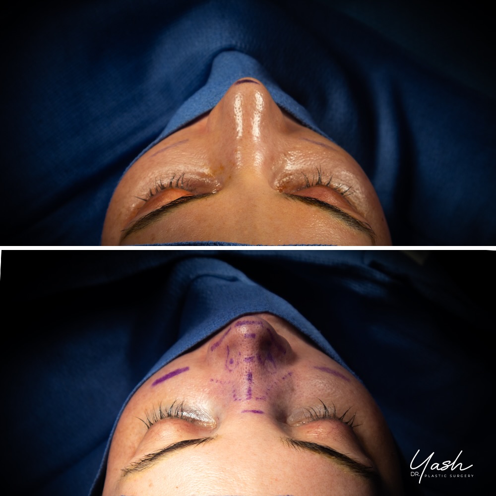 Instagram post by Dr. Yash Avashia: Stunning revision rhinoplasty. ✨ This patient came to me for a revision rhinoplasty, 5 years after her first, with a clear vision for her ne…
