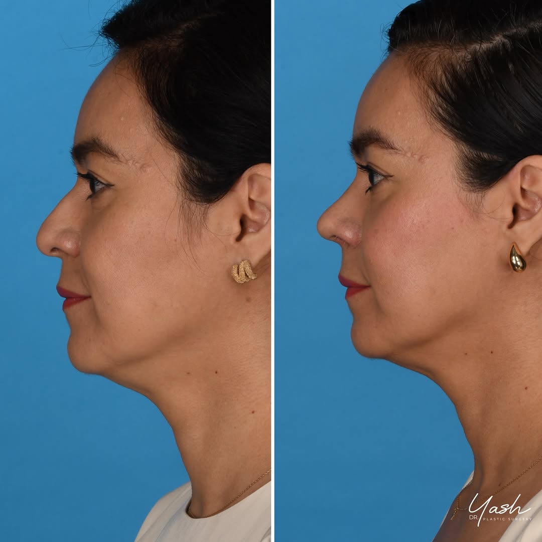 Instagram post by Dr. Yash Avashia: 43 years of looking in the mirror and feeling like her nose didn’t quite match her. Here’s what changed. 🌷 She came to me for a primary rhi…