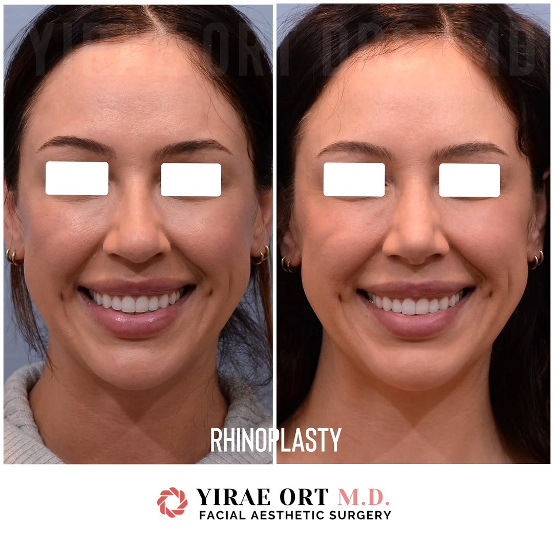 Instagram post by Dr. Yirae Ort: One year post rhinoplasty ✨️💖 We achieved the patient's goals to have a smaller and more defined nasal tip, straighten the axis of her nose…