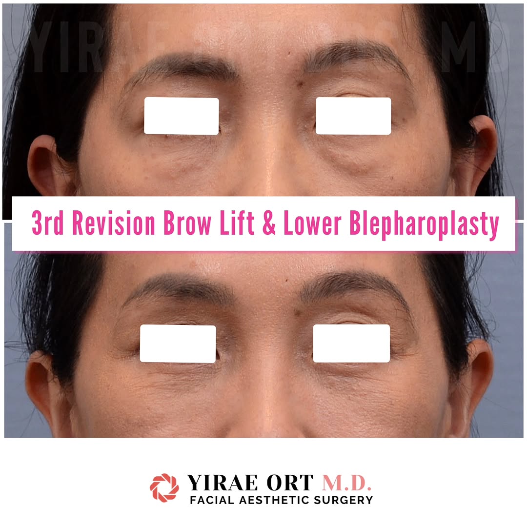 Instagram post by Dr. Yirae Ort: This wonderful patient came to see me after feeling dissatisfied by the surgeries she had on her brows and lower eyelids with another surgeo…