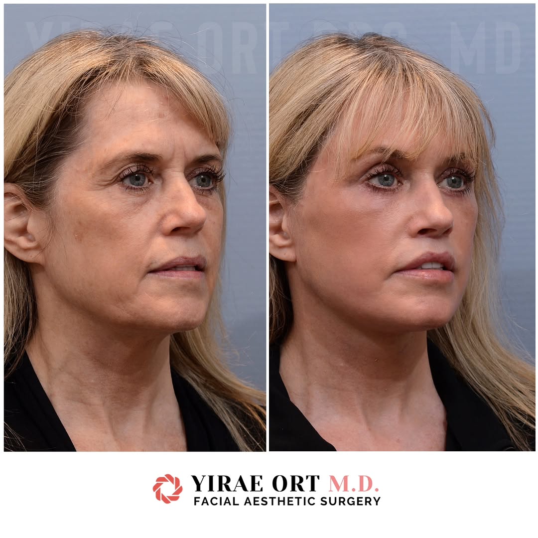 Instagram post by Dr. Yirae Ort: This beautiful patient underwent a deep plane face and neck lift, lateral browlift, upper blepharoplasty, lower blepharoplasty, lip lift, fa…