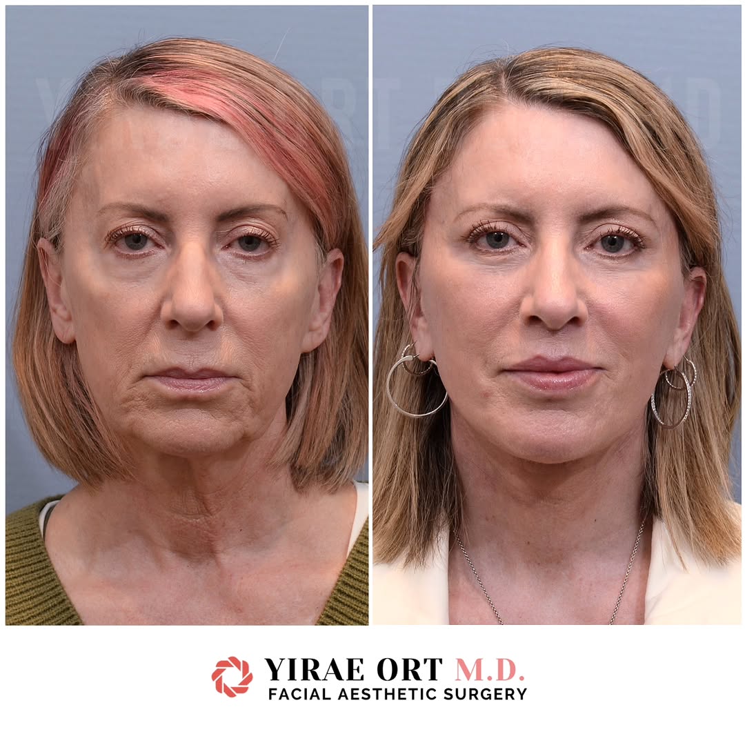 Instagram post by Dr. Yirae Ort: For our lovely patient's total rejuvenation, we combined a few procedures: - Deep plane face and neck lift addressing deep neck fat, anterio…