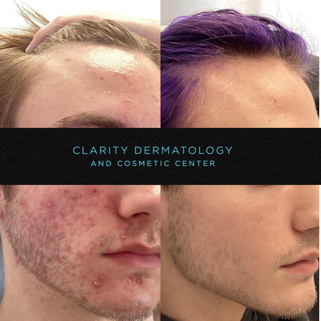 Instagram post by Dr. Yuri M. Kim: Happy Thursday ☃️🎄 Christmas is just around the corner! Here is a #beforeandafter of a patient who came in for #acnetreatment. This patient…