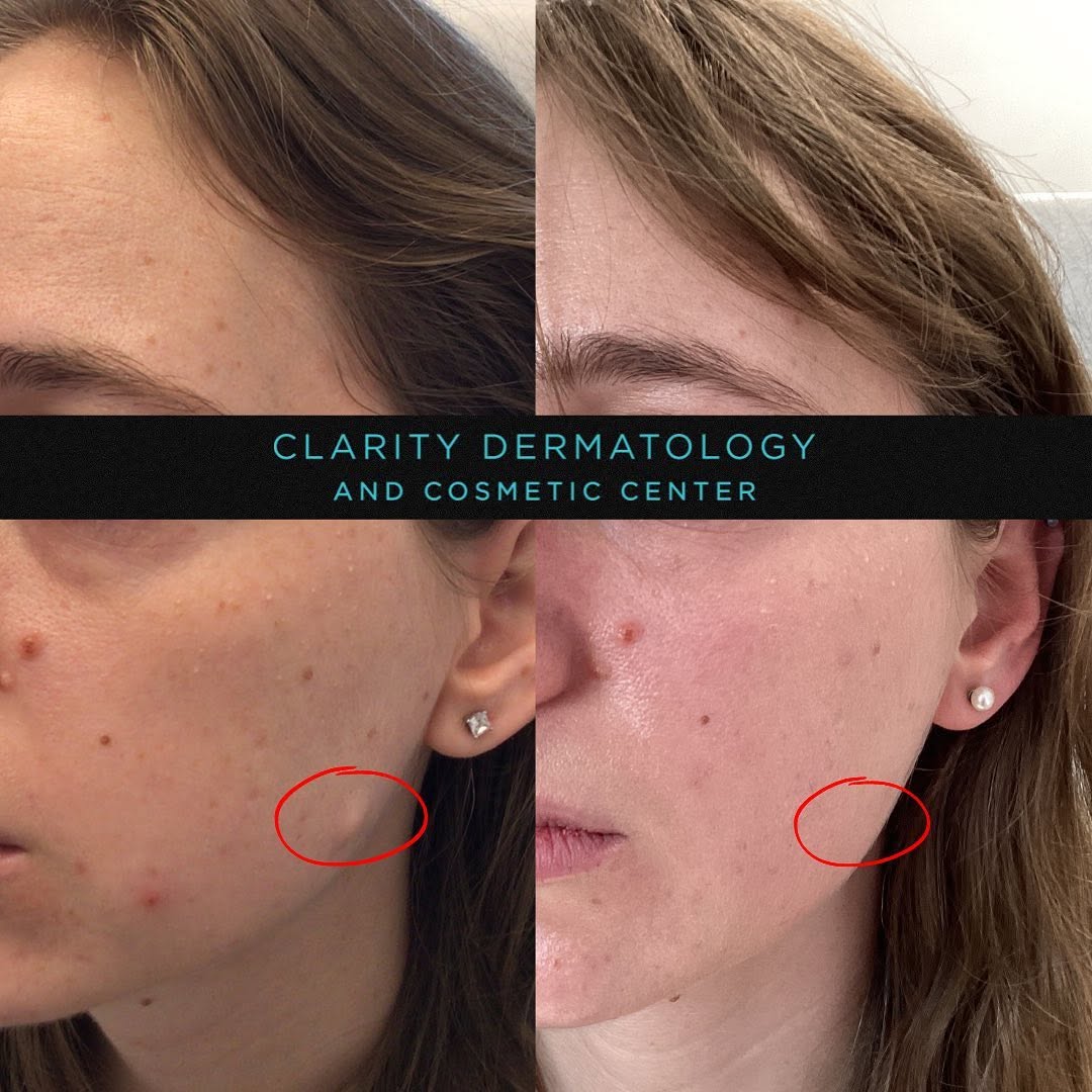 Instagram post by Dr. Yuri M. Kim: Happy Friday 🌹 Interested in #cosmeticremoval of a benign skin lesion? This patient came in for a skin lesion that she had for years. After…