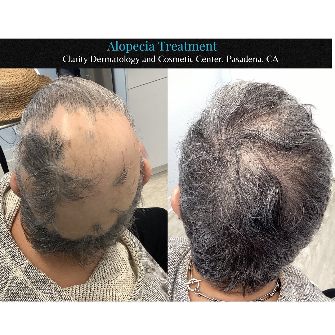 Instagram post by Dr. Yuri M. Kim: Happy Monday Everyone!🐰🌼 These are before and after photos of a patient who treated by Dr. Kim for alopecia. Call us to book a consultatio…