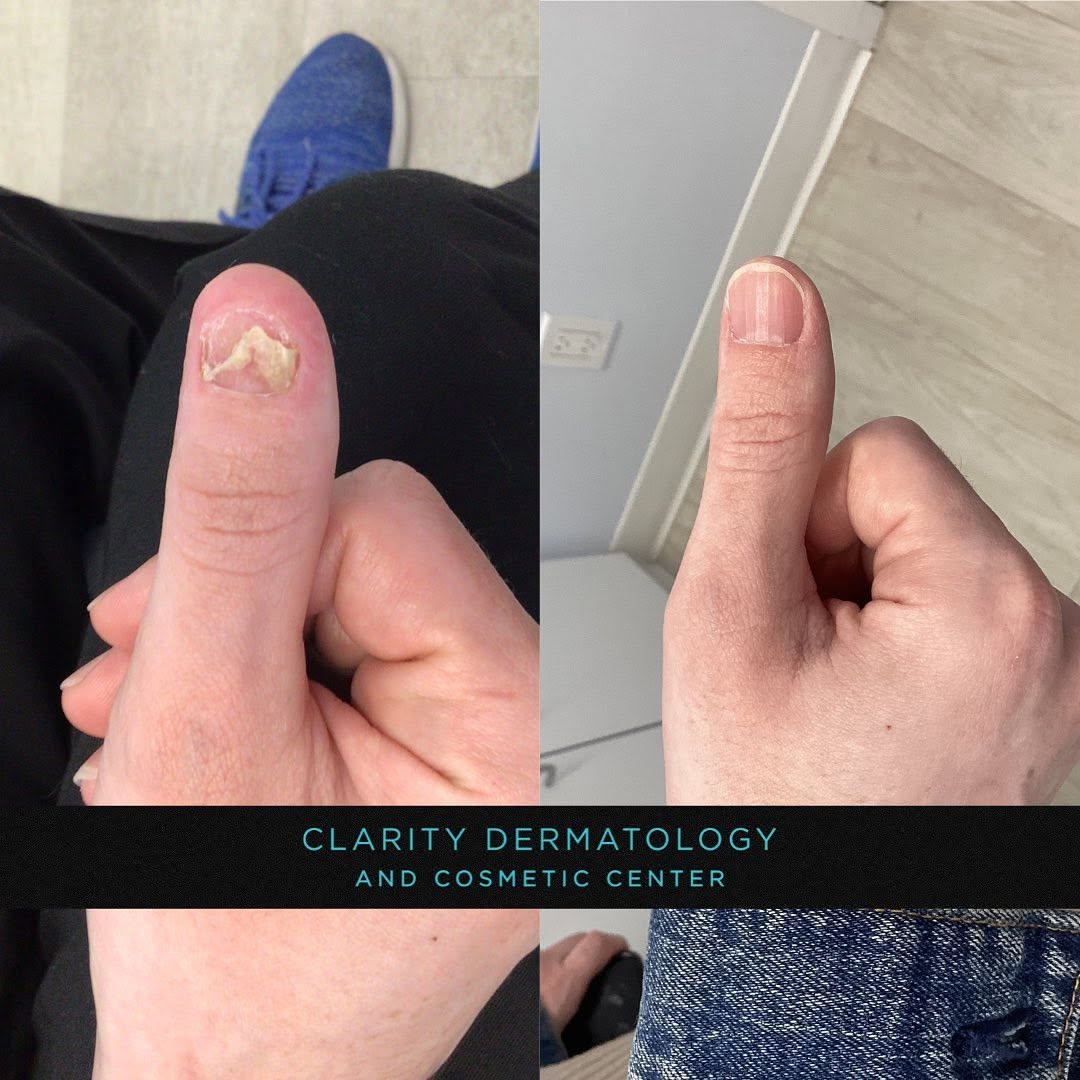 Instagram post by Dr. Yuri M. Kim: Happy Friday Everyone 💐 This is a before and after photo of a patient came in with severe nail damage. Have a nail problem that your concer…