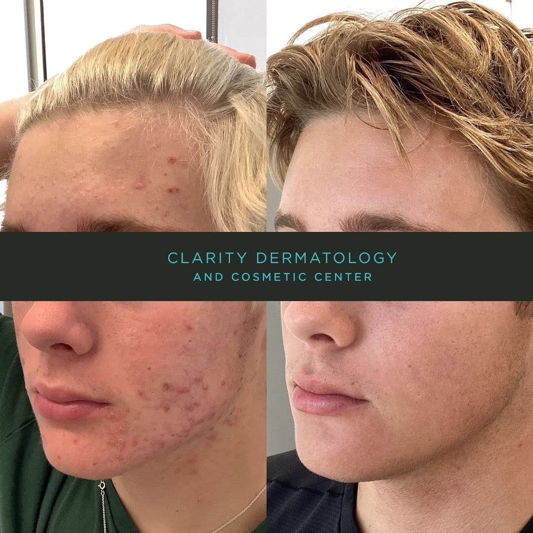 Instagram post by Dr. Yuri M. Kim: Happy Friday 🌼 Here is a #beforeandafter of a patient who came in for acne treatment. He was treated by our #boardcertifieddermatologist, D…