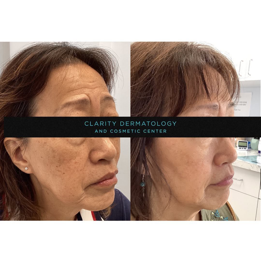 Instagram post by Dr. Yuri M. Kim: ✨✨✨AGE SPOT/SUN SPOT/BROWN SPOT REMOVAL Happy Tuesday 🌸 This patient came in with brown spots/age spots/sun spots that she had for years. A…