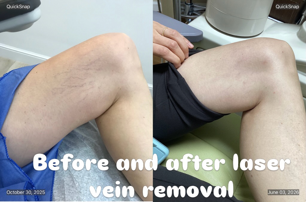 Instagram post by Dr. Yuriy Yagudin: #laserveintreatment #spiderveinremoval #spiderveinstreatment #laservein