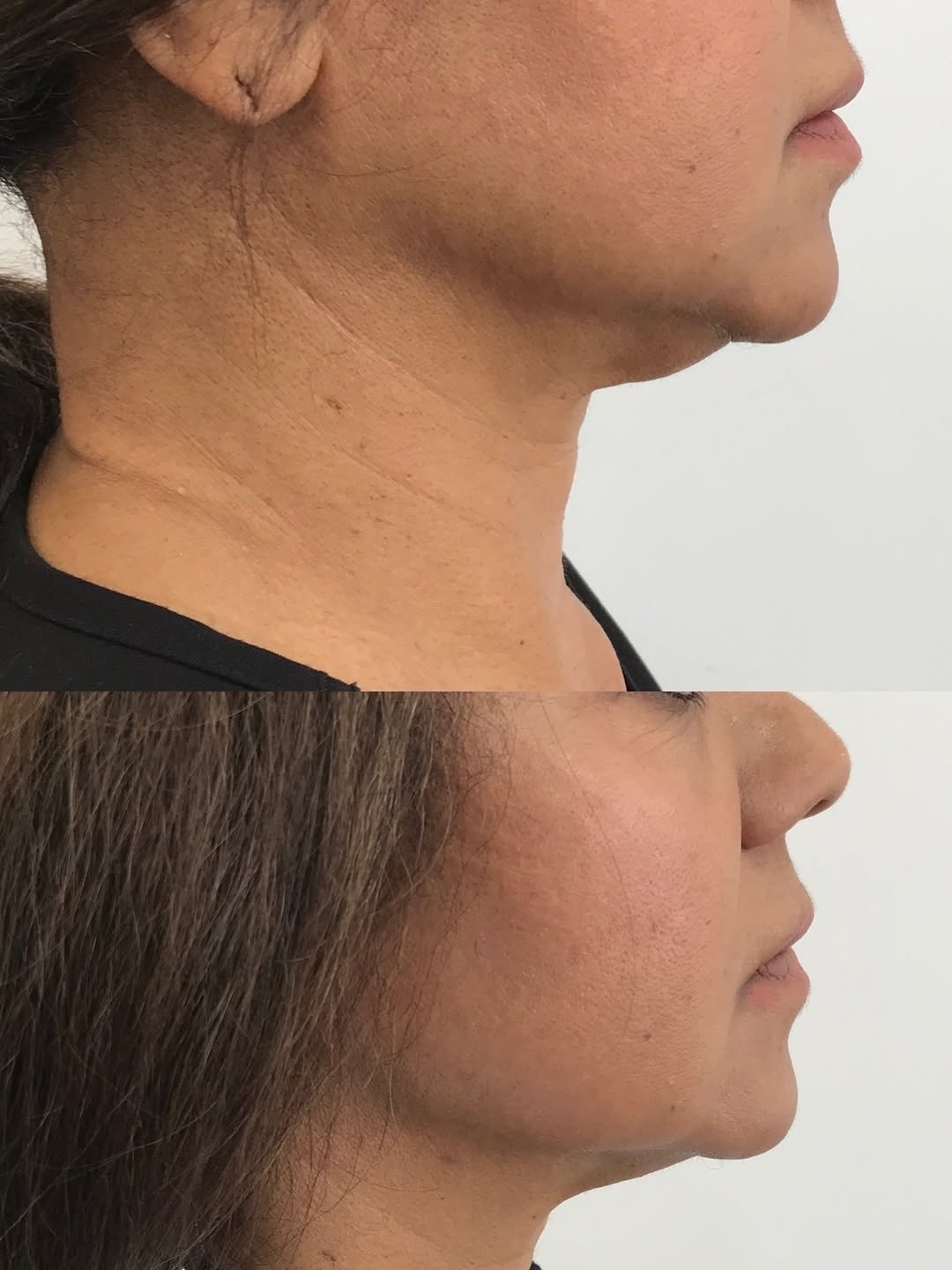 Instagram post by Dr. Yuriy Yagudin: Endolift by Eufotona #endolift #endoliftinglaser #lipo