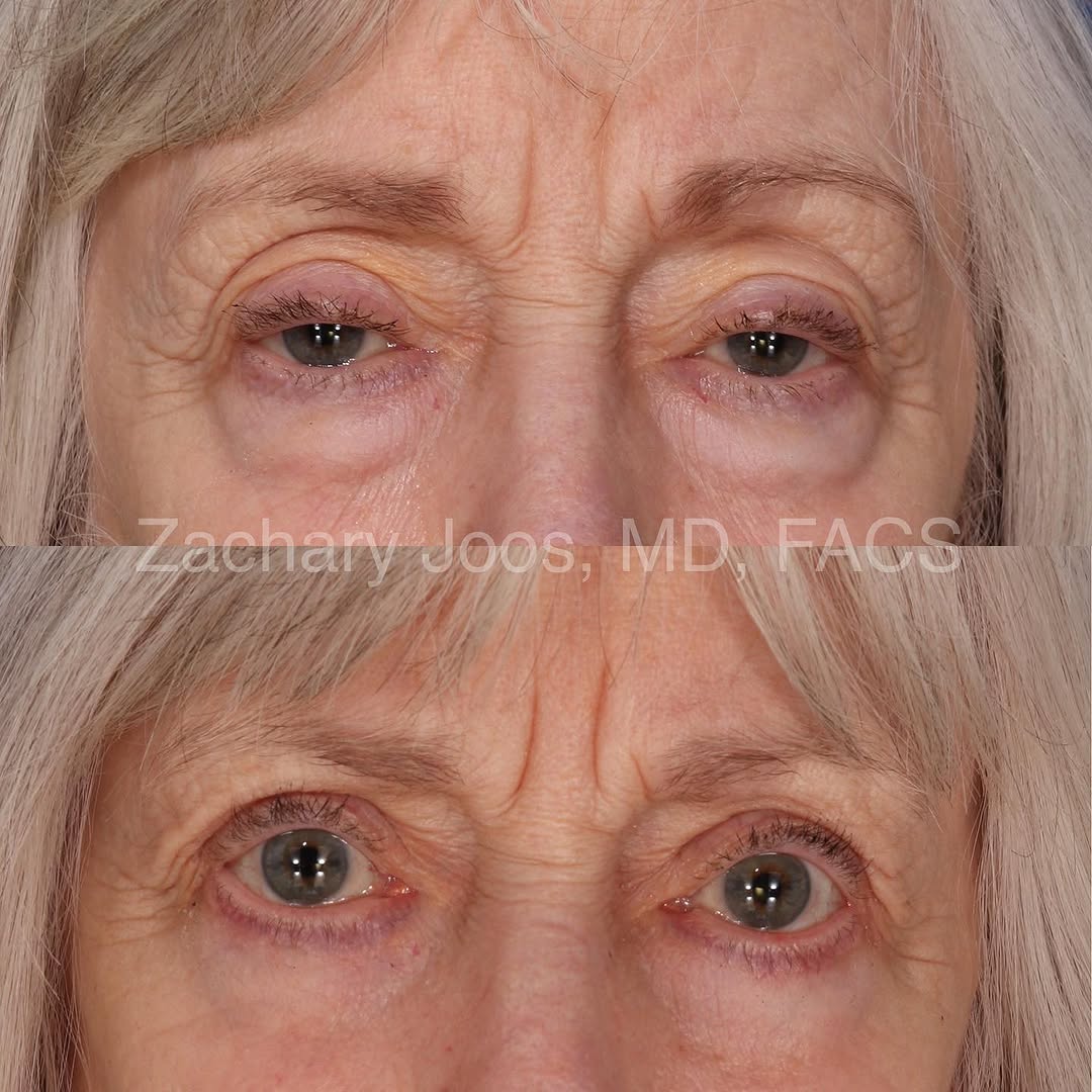 Instagram post by Dr. Zachary Joos: Natural refreshed 👀 after an upper eyelid ptosis repair and cosmetic upper and lower blepharoplasty. She is thrilled to be able to see agai…