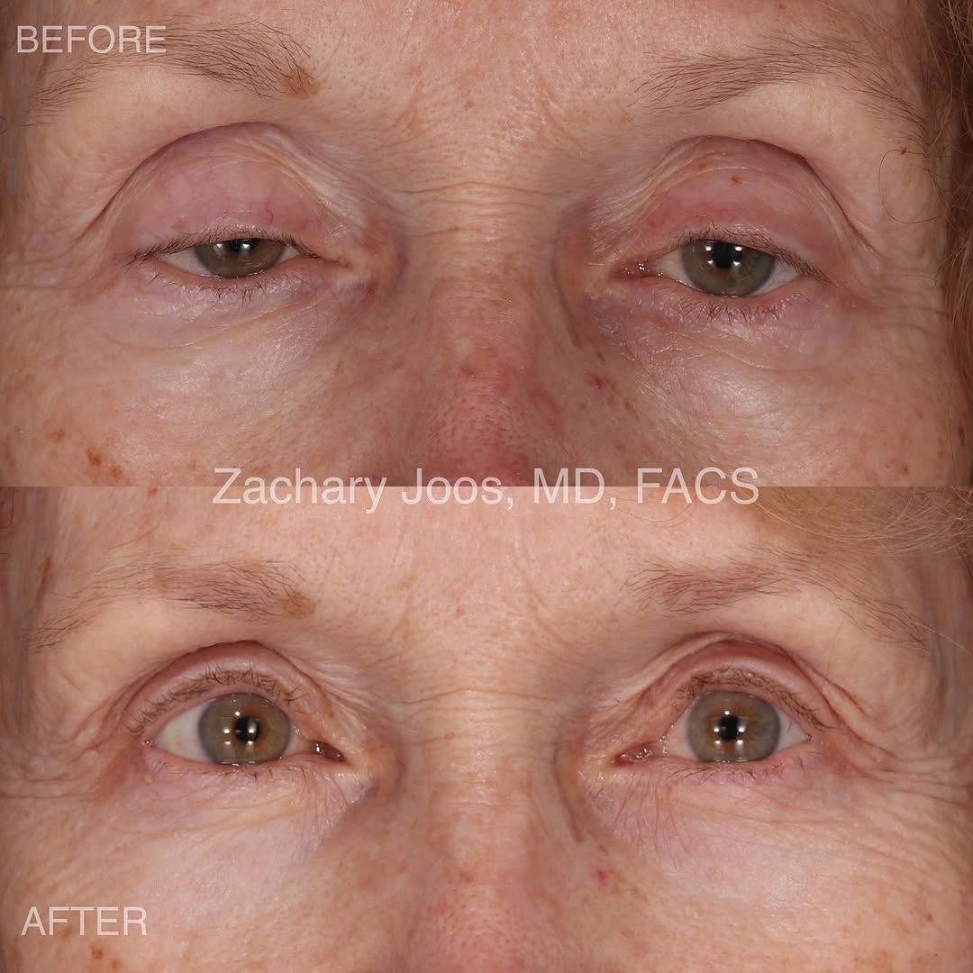 Instagram post by Dr. Zachary Joos: This patient came to see me @marinaparkplastics with trouble seeing well enough to drive and read. She underwent upper lid #ptosisrepair to …