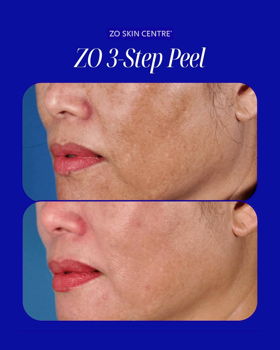 Instagram post by Dr. Zein E. Obagi: Our most requested chemical peel for dramatic results. 🤝 Unlike ordinary spa facials, this chemical peel combines exfoliating acids, a high…