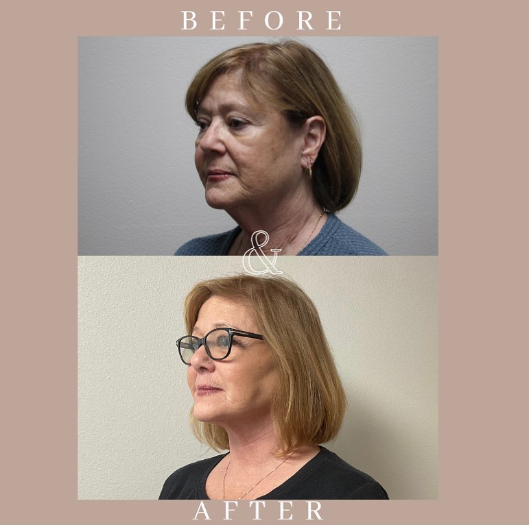 Instagram post by Dr. Zol Kryger: ✨Revitalize, Rejuvenate and Refresh✨ This is our 69 year old patient who underwent a facelift & neck lift! This cosmetic surgical procedure …
