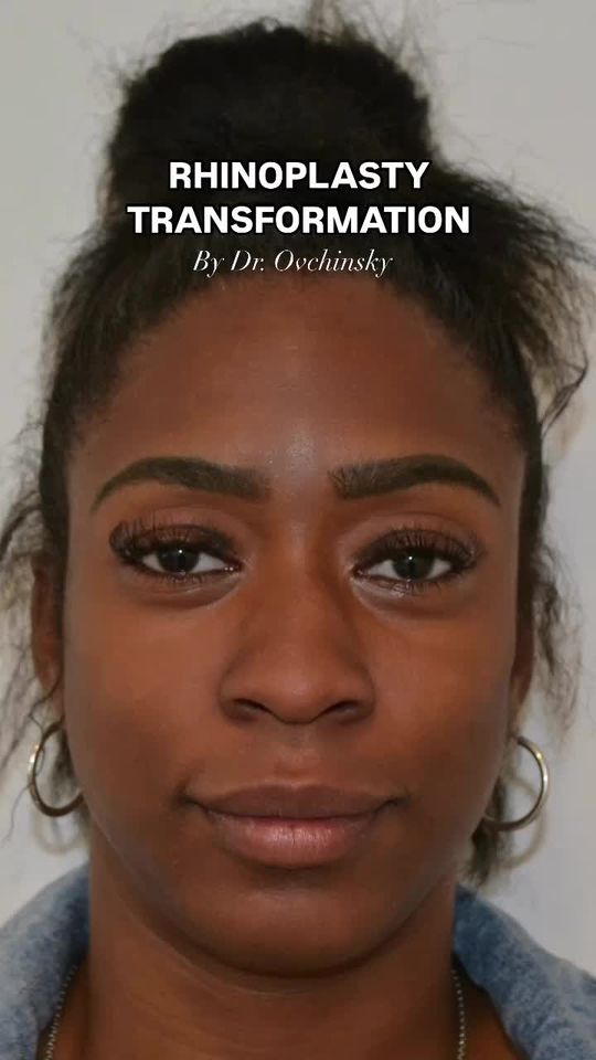 Video by Dr. Alexander Ovchinsky: Ethnic rhinoplasty transformation 🙌 I adressed her alar flaring and widened nasal base creating…