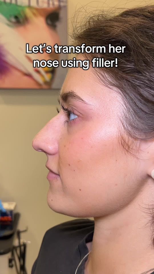 Video by Dr. Alexander Ovchinsky: The power of filler! 🙌 Watch her nose completley improve shape as I perform a nonsurgical nose j…