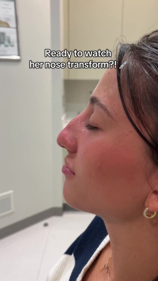 Video by Dr. Alexander Ovchinsky: Camoflauging the appearance of her dorsal hump with a nonsurgical nose job! 💉👃