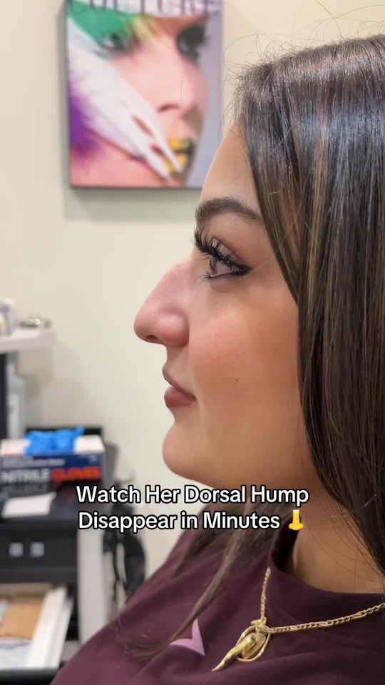 Video by Dr. Alexander Ovchinsky: Watch her dorsal hump disappear in minutes! 💉👃