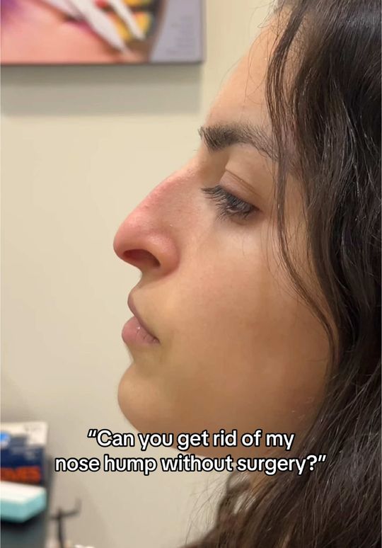 Video by Dr. Alexander Ovchinsky: Watch as I use filler to get rid of the appearance of her nose hump IN MINUTES!👃
