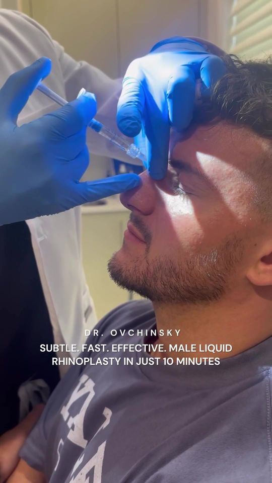 Video by Dr. Alexander Ovchinsky: Subtle. Fast. Effective. Male liquid rhinoplasty in just 10 minutes.