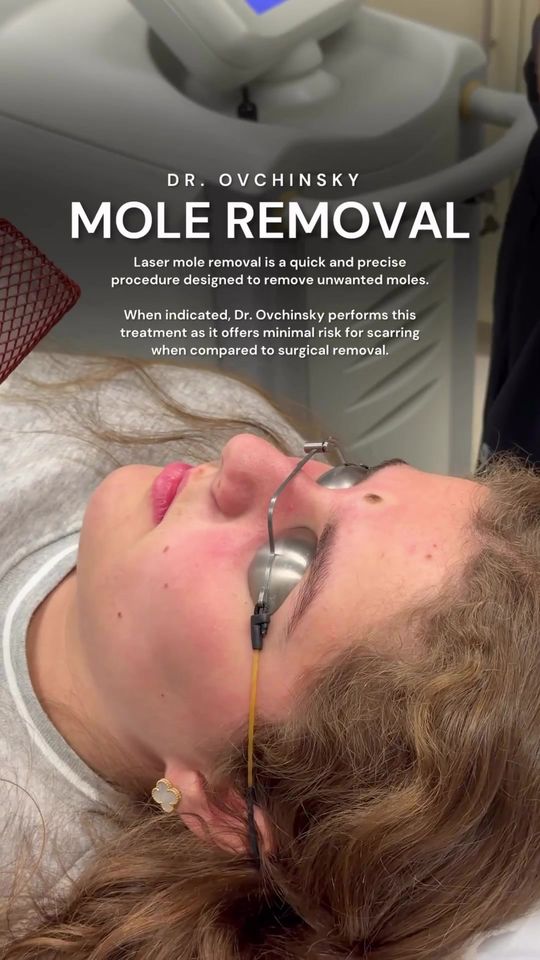 Video by Dr. Alexander Ovchinsky: Professional mole removal is a quick, precise procedure designed to give you smoother, clearer, a…