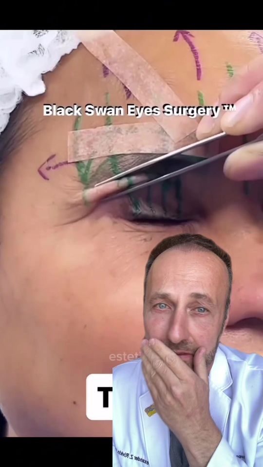 Video by Dr. Alexander Rivkin: More black swans! What she received seems to be a direct brow lift and a very aggressive upper bl…