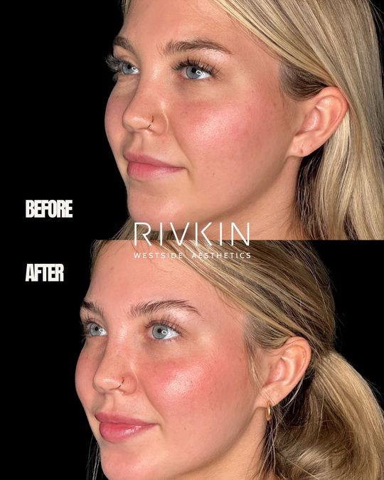Video by Dr. Alexander Rivkin: The trend right now is clear: less volume, more balance. Presile’s approach? Enhance what was alr…