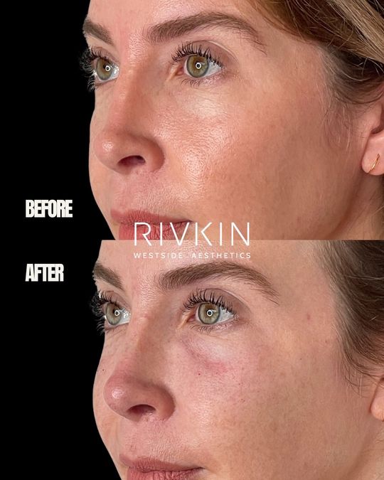 Video by Dr. Alexander Rivkin: Cheek filler is one of my favorite ways to restore harmony in the midface. 💉 When volume natural…