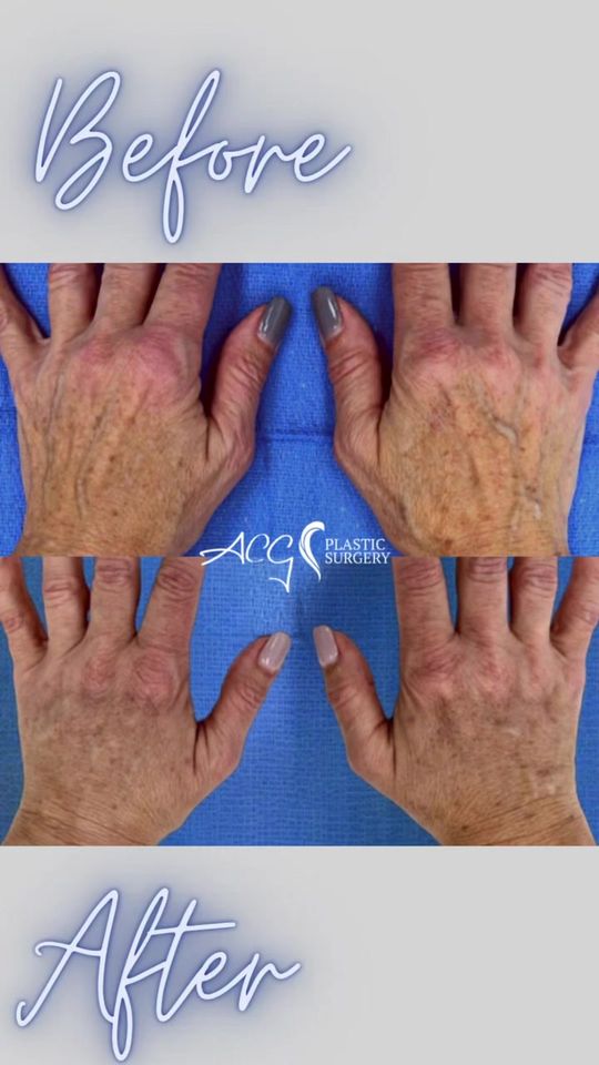 Video by Dr. Alexandra Conde-Green: Fat grafting to the hands 🙌. Fill these hands to smoothen their aspect. Bye bye 👋 prominent vei…