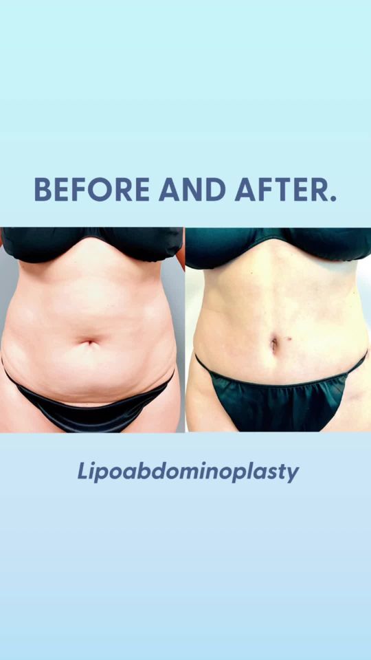 Video by Dr. Alexandra Conde-Green: ✨ Discover the transformative power of lipoabdominoplasty! Say hello to a sleeker, contoured abdo…