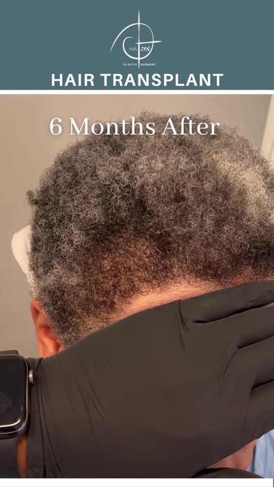 Video by Dr. Alexes Hazen: Amazing results 6 months post op using state of the art Follicular Unit Extraction and Transfer o…