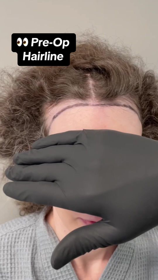 Video by Dr. Alexes Hazen: With our state of the art Neograft machine, we can completely transform your hairline with no sca…