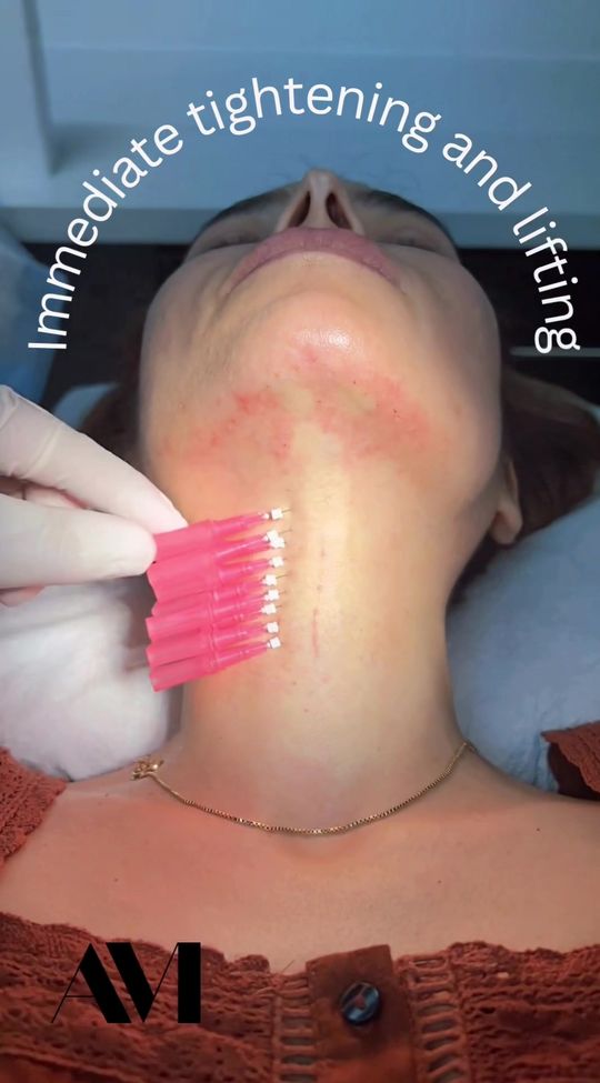 Video by Dr. Alonso Martin: 💁🏼‍♀️Lift, Sculpt, & Rejuvenate✨ 🪡PDO threads offer an excellent option for patients intereste…