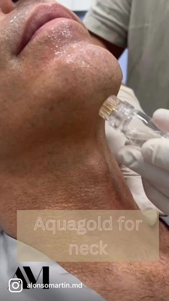 Video by Dr. Alonso Martin: “May your day be as as your skin”💁🏻‍♂️ ✨Aquagold Fine Touch offers a truly customised skincare…