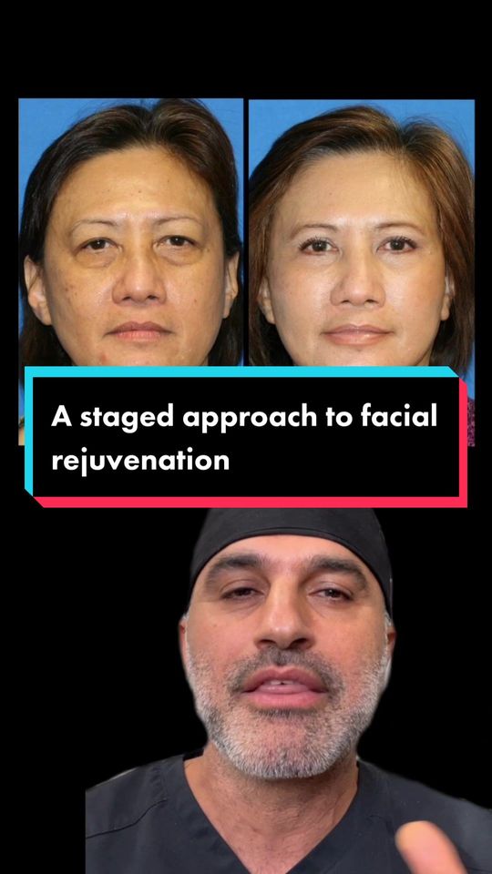 Video by Dr. Amir M. Karam: People want to look as young as they feel. That’s why they come to see me. In order to achieve th…