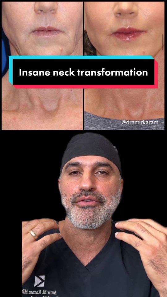 Video by Dr. Amir M. Karam: How do we address neck aging and sagging? It’s important to know that neck aging is a symptom of…