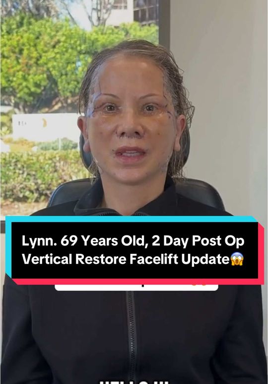 Video by Dr. Amir M. Karam: Lynn is 69, almost 70, and this is just 2 days post-op from her Vertical Restore facelift (full p…