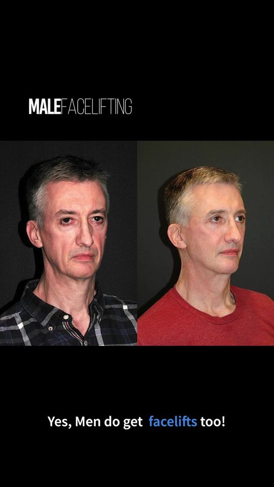 Video by Dr. Andrew Jacono: Today I saw this 58 year old man 5 months after I performed his with me. I told him he looks 20 y…