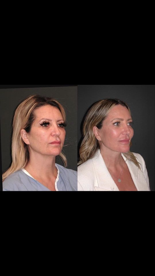 Video by Dr. Andrew Jacono: Today I saw this beautiful 60 year old patient of mine 1 year and I performed her plastic surgery…