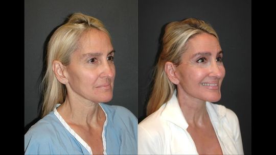 Video by Dr. Andrew Jacono: I was totally blown away today when I saw this beautiful 59 year old woman today only 2 months af…